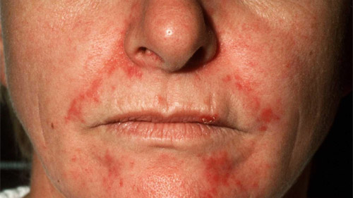 Стероидные угри и дерматит на лице лечение, фото фото