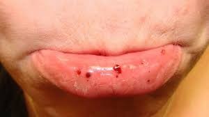 Кровяной прыщ внутри губы