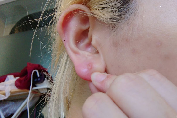 Прыщ на мочке уха: причины, что делать с внутренним, подкожным фото