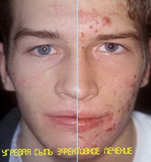 Лечение угревой сыпи на лице у подростков и взрослых, причины фото