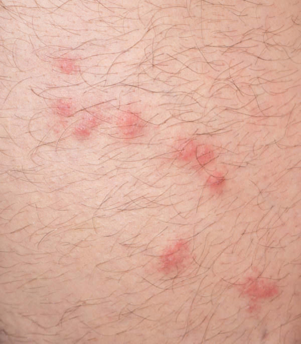 Прыщи на теле похожие на укусы комаров чешутся фото