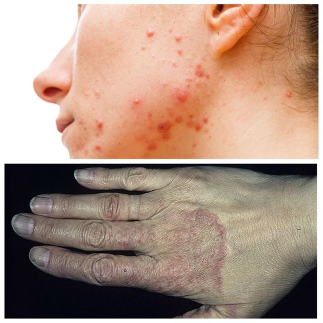 Подкожные паразиты у человека: симптомы