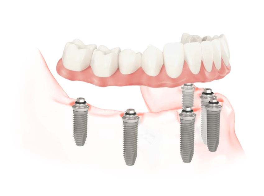 Имплантация зубов all on 6. Имплантологическая кассета Nobel полный набор для all on 4. Имплантация зубов по технологии all-on-6 ("все на шести").. Имплантация зубов по технологии all-on-4 ("все на четырех").