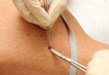 Методы лечения рака кожи