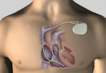 Как работает кардиостимулятор?