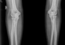 В каких случаях нужно делать рентген локтя?