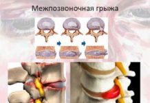 Виды межпозвоночных грыж поясничного отдела