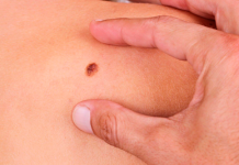 Диагностика меланомы: как распознать на ранних стадиях?