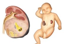 Нейробластома: симптомы, диагностика, методы лечения