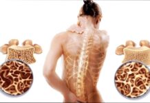 Современные подходы к диагностике и лечению остеопороза