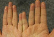 Причины гипергидроза ладоней