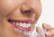 Ортодонтическое лечение с помощью элайнеров