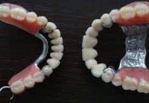 Съемные зубные протезы при полном отсутствии зубов