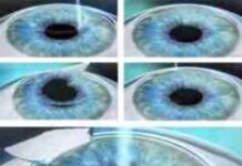 Фемто Ласик: самая современная и уникальная методика лазерной коррекции зрения