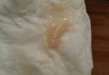 Причины розовых выделений во время беременности