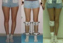 Как исправить кривизну ног?