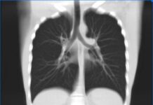 Когда необходимо делать КТ легких?