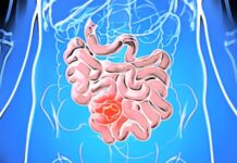 Рак тонкого кишечника: симптомы