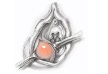 Бартолинит: опасное воспаление женских половых органов