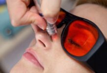 Какие проблемы решает лазерное удаление сосудистых звёздочек?