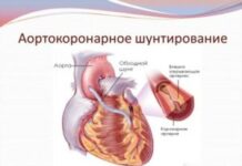 Аортокоронарное шунтирование в Германии: основной способ лечения ИБС