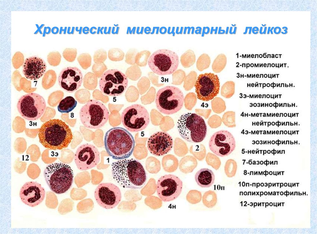 Хр миелолейкоз картина крови