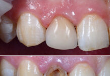 Способы восстановления утраченных зубов