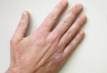 Симптомы псориаза