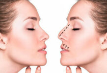 Что такое безоперационная ринопластика