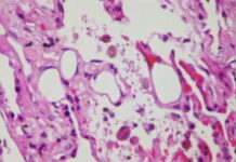 Симптомы жировой эмболии