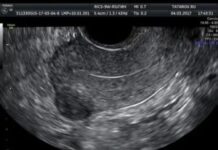 Ультразвуковая анатомия органов малого таза у женщин