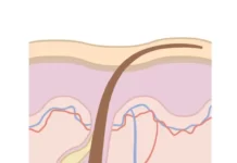 Как бороться с вросшими волосами?