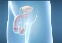 Что такое лигаментотомия?