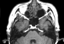 Что показывает МРТ черепно-мозговых нервов?