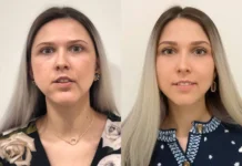 Исправление асимметрии лица. Гнатолог или пластический хирург?