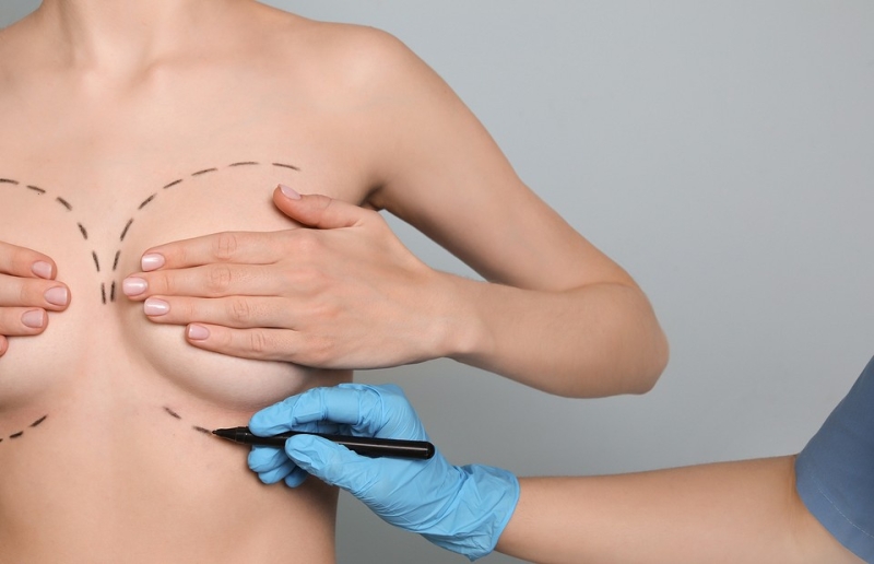 Пластика груди: что важно спросить у врачей до операции