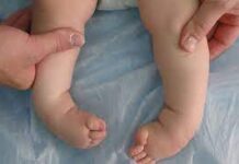 Врожденная косолапость у детей: причины, диагностика, лечение