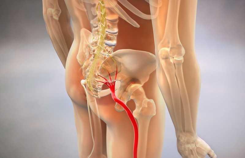 Защемление седалищного нерва: почему «стреляет» в спине или ноге и как это лечить 