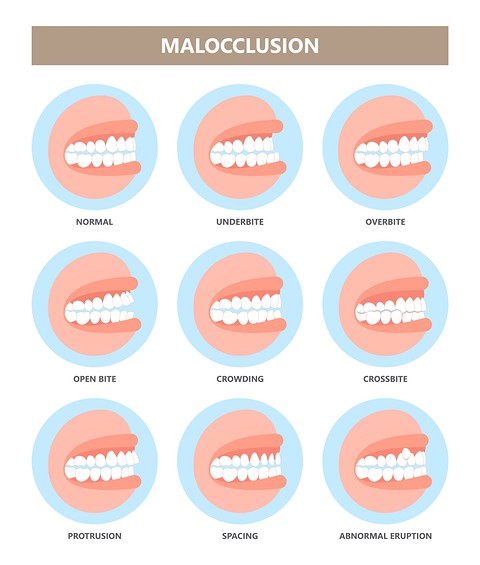 Правильный прикус: 4 мифа, которые давно пора развеять (разбираемся со стоматологом)