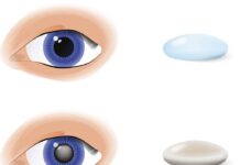 Как лечить катаракту: диагностика и профилактика?