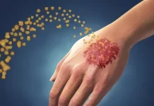 Что такое псориаз и как он лечится