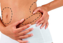 Липосакция или абдоминопластика? Чем отличаются, какую операцию лучше выбрать?