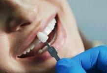 Виниры после установки: уход и ограничения