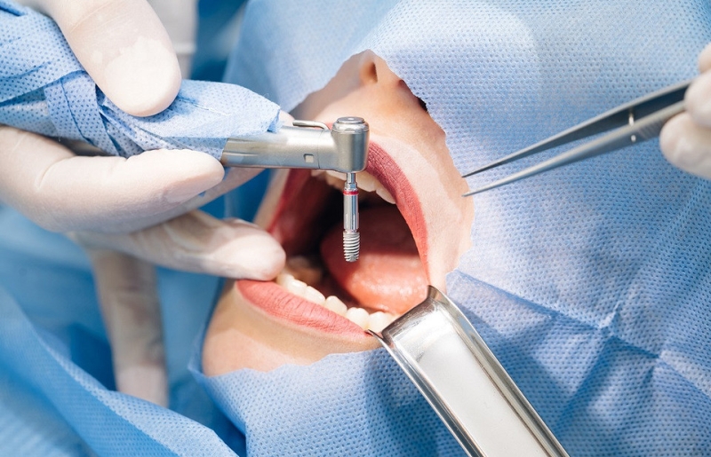 Седация и наркоз в стоматологии: как выбрать и точно получить безопасное лечение